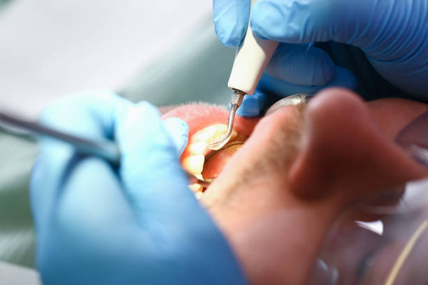 Best Emergency Dental Extractions in Franklin, GA
